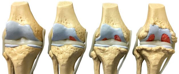 tổn thương khớp ở các giai đoạn phát triển khác nhau của bệnh viêm khớp cổ chân