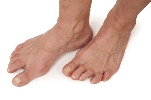 bàn chân bị ảnh hưởng bởi chứng khô khớp