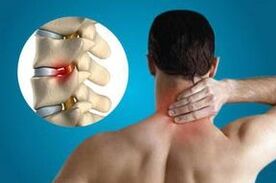 Sự chụm của đốt sống