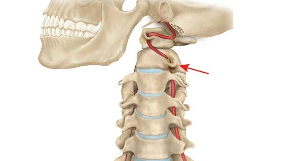 thoái hóa xương cột sống cổ