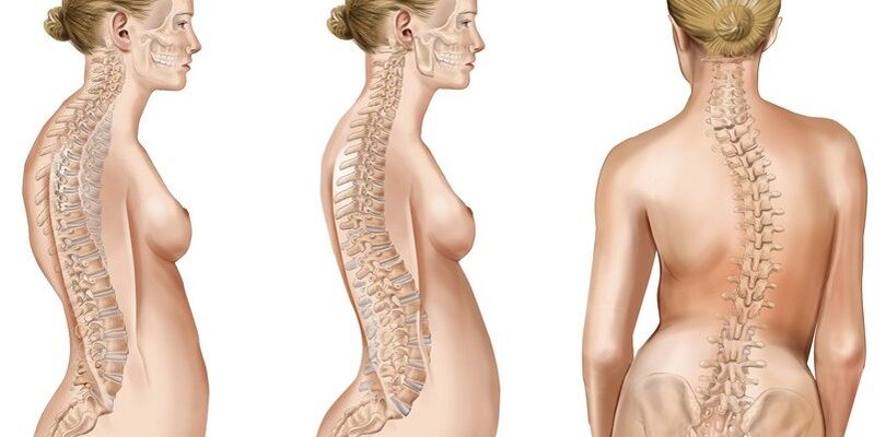 Vẹo cột sống ngực gây đau ở xương bả vai