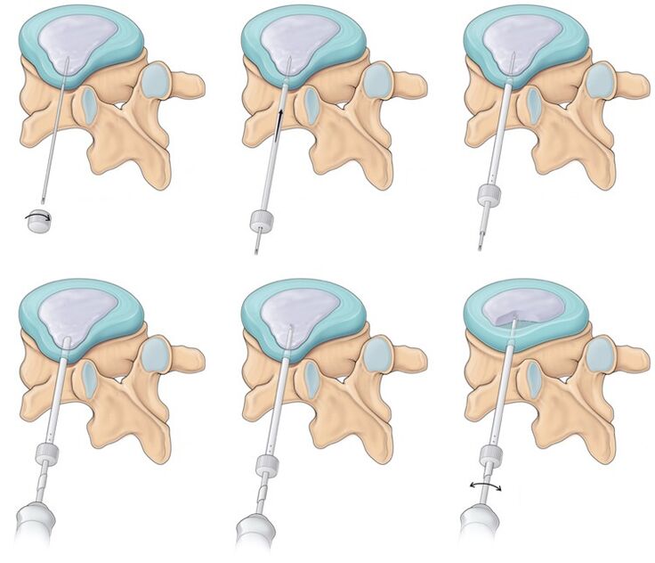 phẫu thuật chữa đau lưng