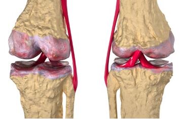 Giãn tĩnh mạch là nguyên nhân phát triển bệnh lậu