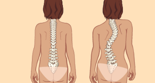 cong vẹo cột sống là nguyên nhân gây ra bệnh u xương thắt lưng