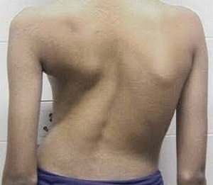cong vẹo cột sống là nguyên nhân gây đau lưng
