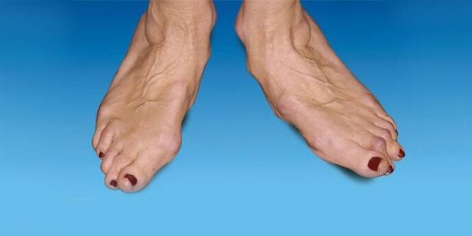 biến dạng của bàn chân với chứng khớp mắt cá chân