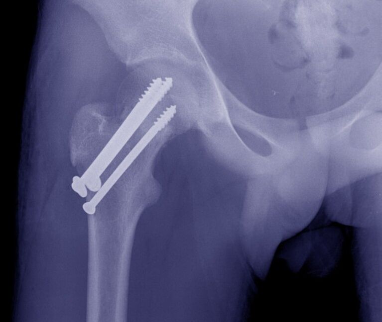 Chụp X-quang khớp háng, nắn xương ổ gãy bằng các dụng cụ cố định bên trong. 