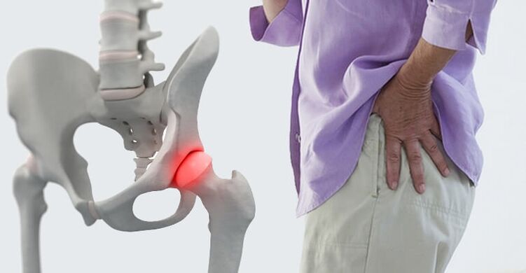 đau ở vùng hông - một triệu chứng của bệnh viêm khớp háng